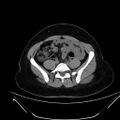 Bilateral ovarian mature cystic teratomas (Radiopaedia 79373-92457 Axial non-contrast 39).jpg