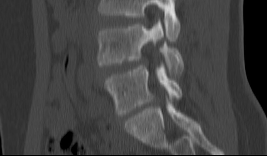 Bilateral pars defect (Radiopaedia 26691-26846 Sagittal bone window 25).jpg