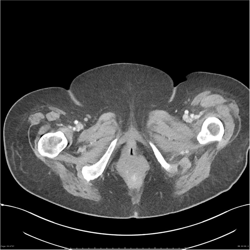 Bilateral psoas hematomas (Radiopaedia 24057-24279 A 94).jpg