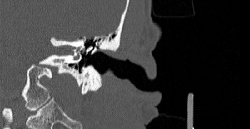 File:Bilateral temporal bone fractures (Radiopaedia 29482-29970 B 30).jpg