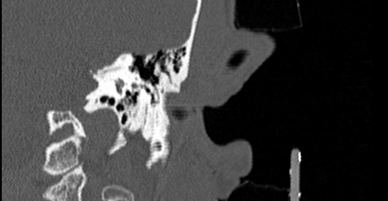 File:Bilateral temporal bone fractures (Radiopaedia 29482-29970 B 47).jpg