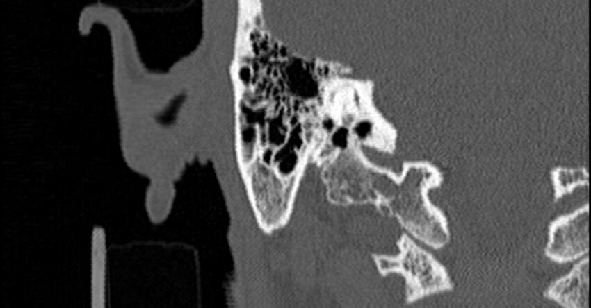 Bilateral temporal bone fractures (Radiopaedia 29482-29970 Coronal non-contrast 143).jpg