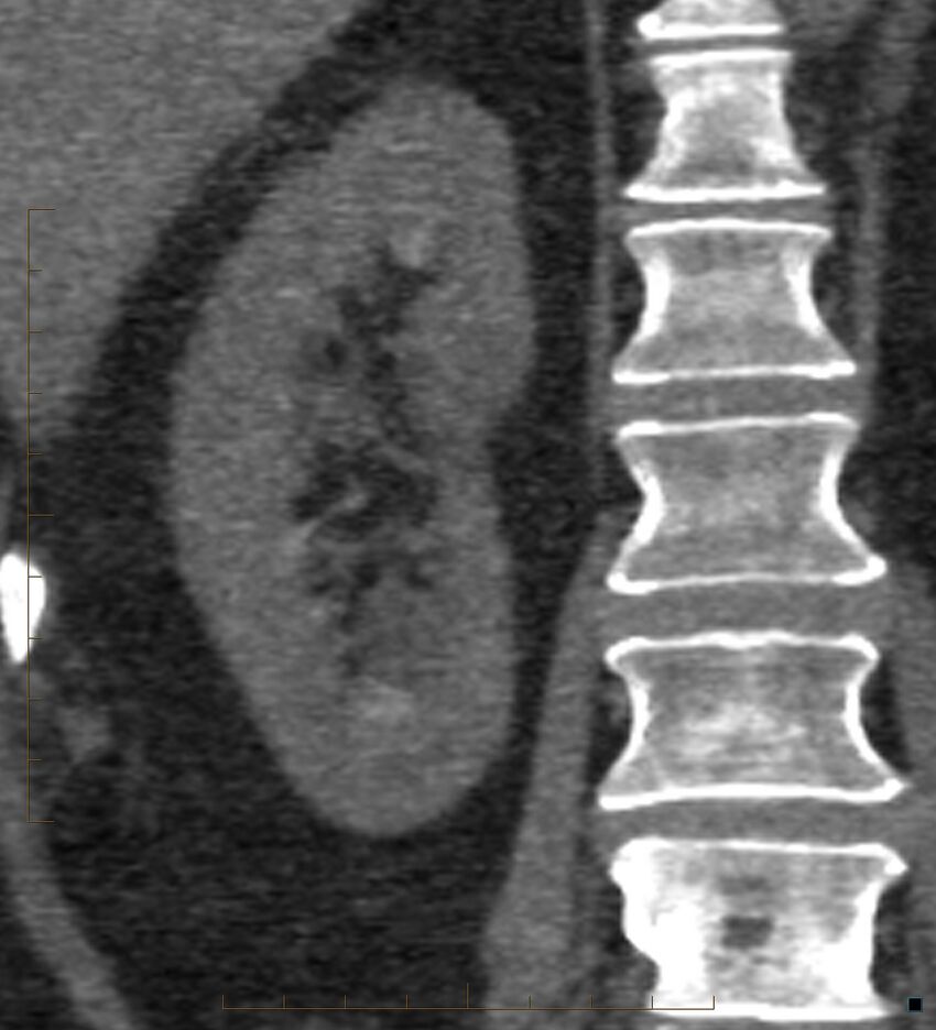 Bile leak from accessory duct(s) of Luschka post cholecystectomy (Radiopaedia 40736-43389 B 55).jpg