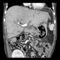 Biliary necrosis - liver transplant (Radiopaedia 21876-21846 C 17).jpg
