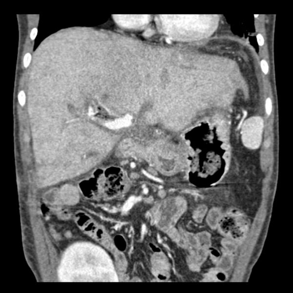 File:Biliary necrosis - liver transplant (Radiopaedia 21876-21846 C 17).jpg