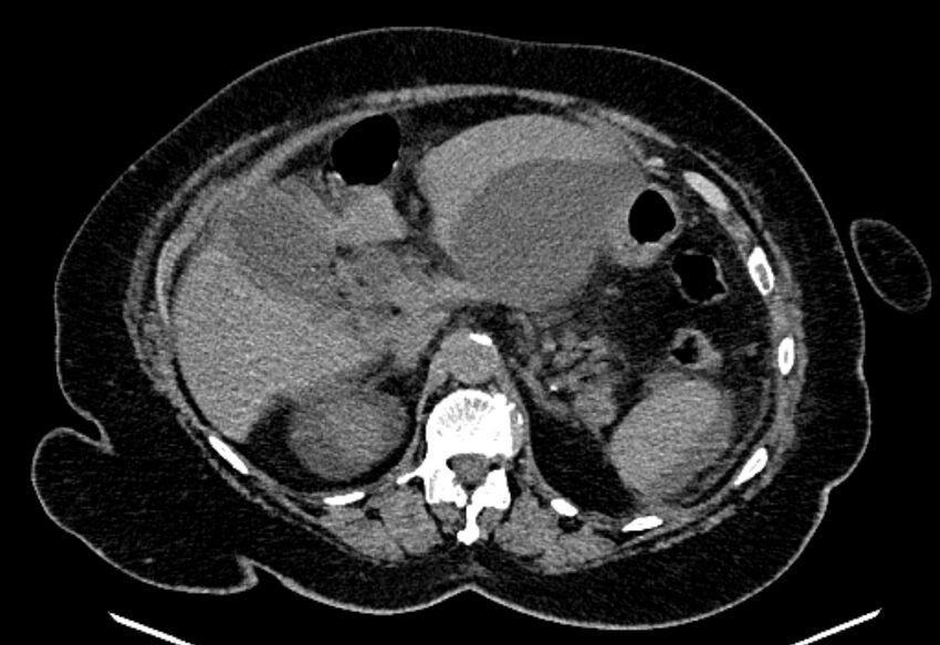 Biliary pancreatitis (Radiopaedia 72289-82823 Axial non-contrast 89).jpg