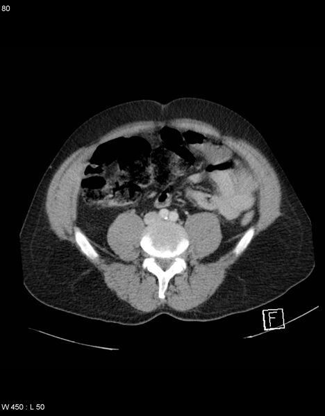 File:Boerhaave syndrome with tension pneumothorax (Radiopaedia 56794-63603 A 40).jpg