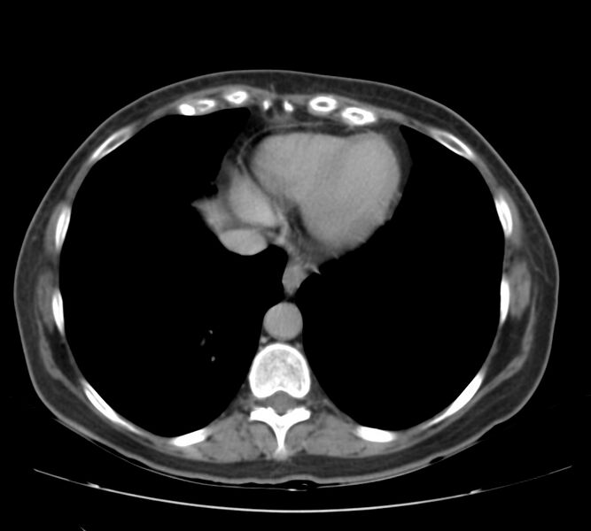 File:Bosniak renal cyst - type IV (Radiopaedia 22929-22953 D 2).jpg