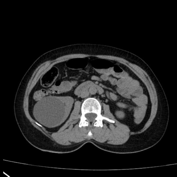 File:Bosniak renal cyst - type I (Radiopaedia 27479-27675 Axial non-contrast 43).jpg
