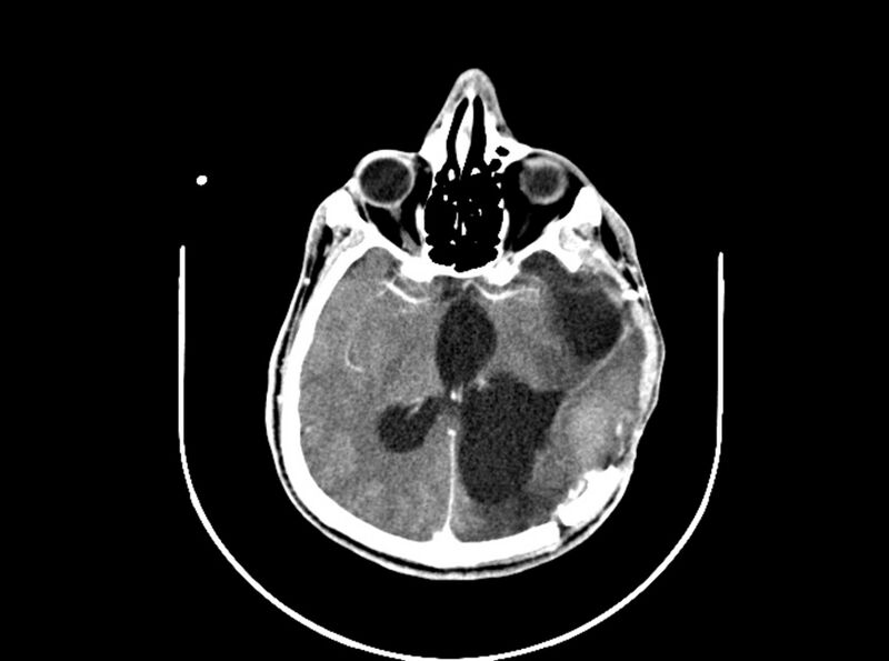 File:Brain injury by firearm projectile (Radiopaedia 82068-96088 B 124).jpg