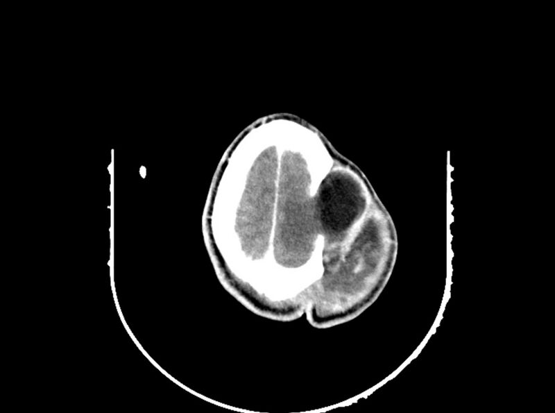 File:Brain injury by firearm projectile (Radiopaedia 82068-96088 B 186).jpg