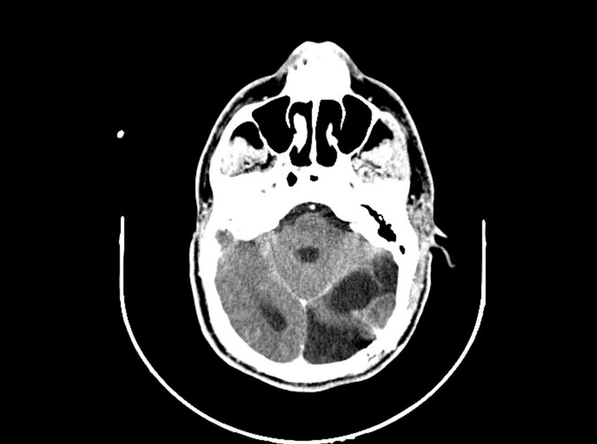 Brain injury by firearm projectile (Radiopaedia 82068-96088 B 94).jpg