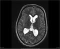 Brainstem glioma (Radiopaedia 21819-21775 Axial T2 21).jpg