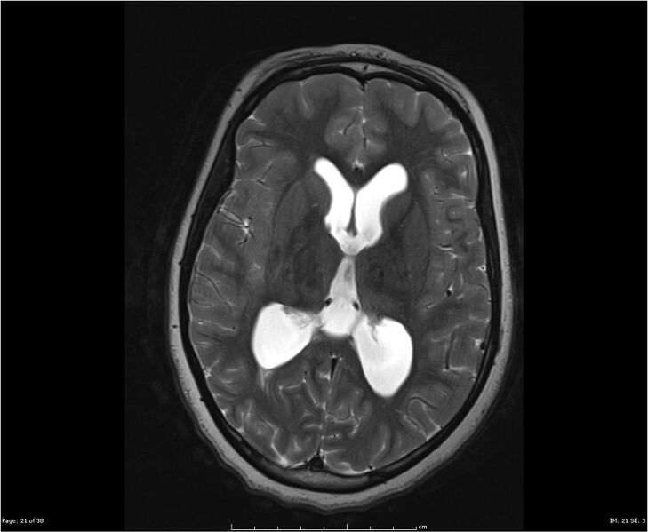 File:Brainstem glioma (Radiopaedia 21819-21775 Axial T2 21).jpg