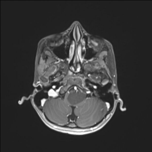File:Brainstem glioma (Radiopaedia 70548-80674 Axial T1 C+ 34).jpg