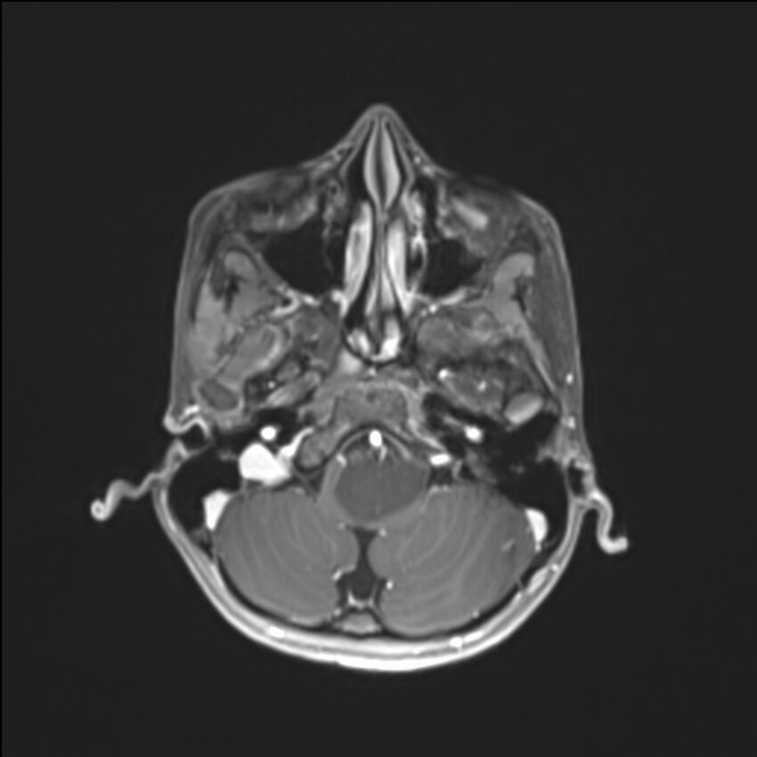 Brainstem glioma (Radiopaedia 70548-80674 Axial T1 C+ 34).jpg