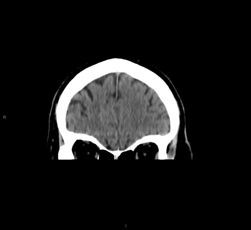 Brainstem hemorrhage (Radiopaedia 58794-66028 Coronal non-contrast 52).jpg