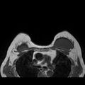 Breast implants - MRI (Radiopaedia 26864-27035 Axial T1 38).jpg