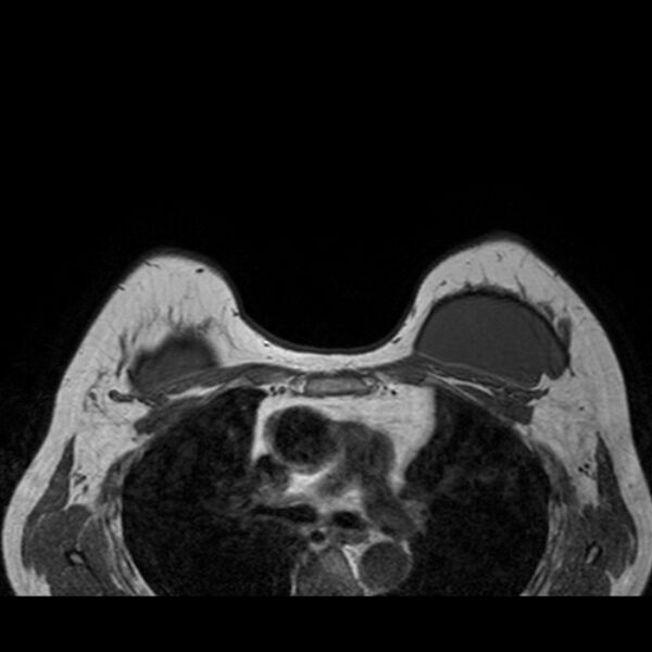 File:Breast implants - MRI (Radiopaedia 26864-27035 Axial T1 38).jpg