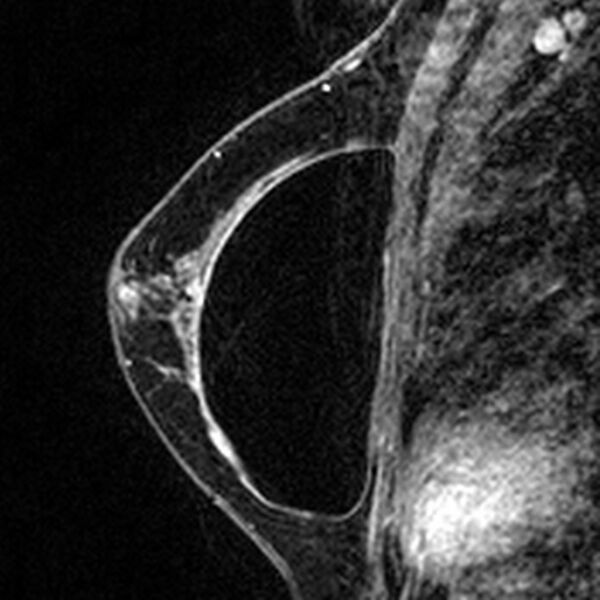 File:Breast implants - MRI (Radiopaedia 26864-27035 Sagittal T2 31).jpg