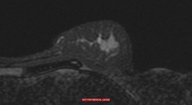 File:Breast lymphoma (MRI) (Radiopaedia 34999-36498 Axial STIR 12).jpg