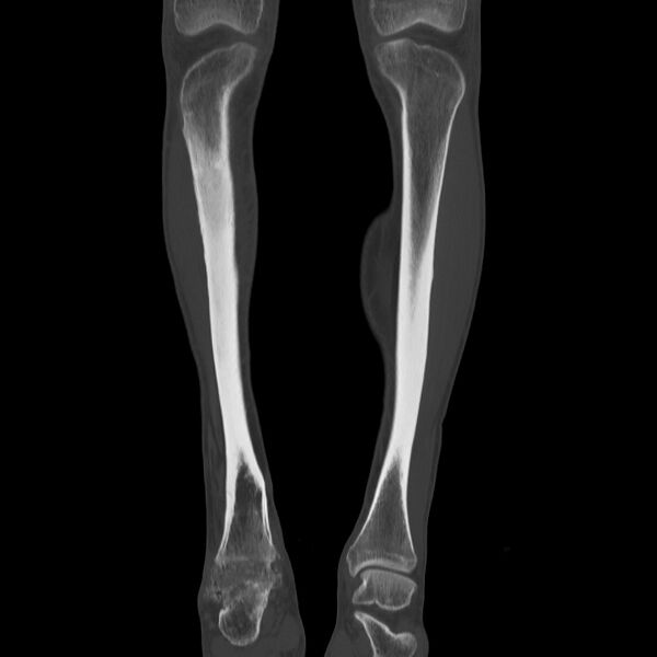 File:Brodie abscess - tibia (Radiopaedia 66028-75204 Coronal bone window 11).jpg