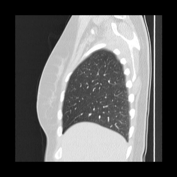 File:Bronchial atresia (Radiopaedia 22965-22992 Sagittal lung window 46).jpg