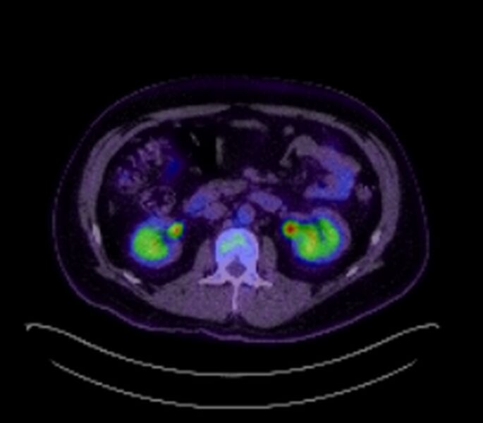 File:Bronchial carcinoid tumor (Radiopaedia 67377-76766 18FDG-PET-CT 44).jpg