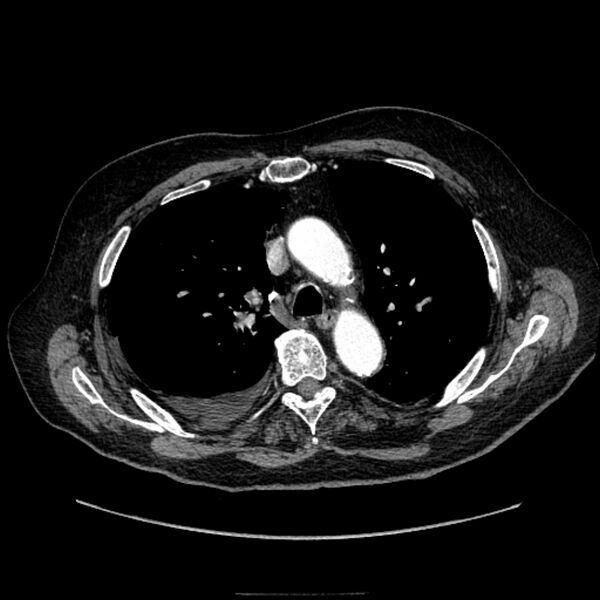 File:Bronchogenic adenocarcinoma and pulmonary embolism (Radiopaedia 9097-9806 D 24).jpg