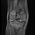 Bucket handle tear - lateral meniscus (Radiopaedia 72124-82634 Coronal PD fat sat 11).jpg