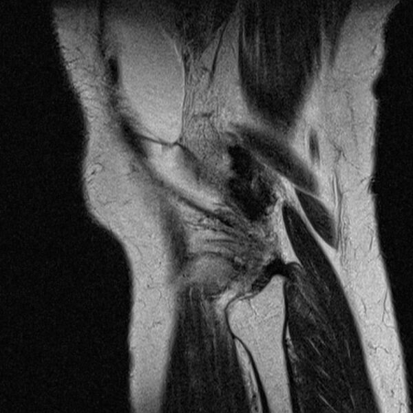 File:Bucket handle tear - medial meniscus (Radiopaedia 79028-91942 Sagittal T2 2).jpg