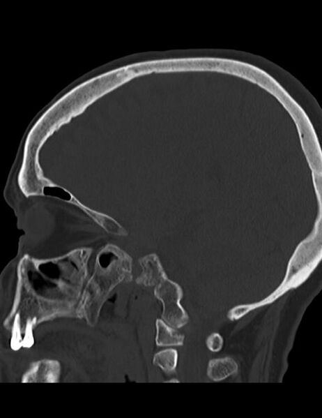 File:Burnt-out meningioma (Radiopaedia 51557-57337 Sagittal bone window 17).jpg