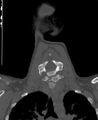 Butterfly vertebra (Radiopaedia 77903-90209 Coronal bone window 31).jpg