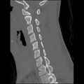 C5 facet fracture (Radiopaedia 58374-65499 Sagittal bone window 42).jpg