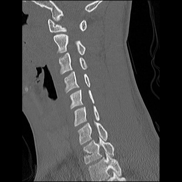 File:C5 facet fracture (Radiopaedia 58374-65499 Sagittal bone window 42).jpg