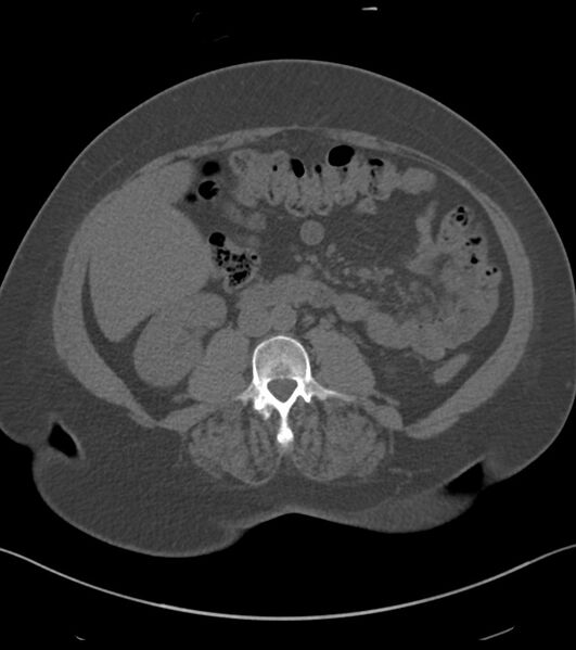 File:Calcified hepatic hydatid cyst (Radiopaedia 81127-94738 Axial non-contrast 52).jpg
