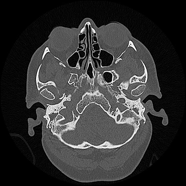 File:Canal up mastoidectomy (Radiopaedia 78108-90638 Axial bone window 33).jpg