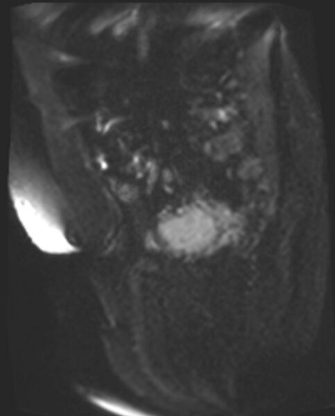 File:Cancer cervix - stage IIb (Radiopaedia 75411-86615 Sagittal DWI 42).jpg