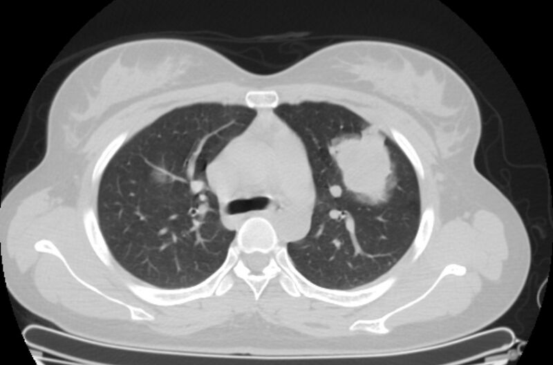 File:Cannonball metastases - uterine choriocarcinoma (Radiopaedia 70137-80173 Axial lung window 26).jpg