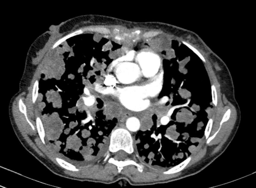 Cannonball metastases from breast cancer (Radiopaedia 91024-108569 A 63).jpg