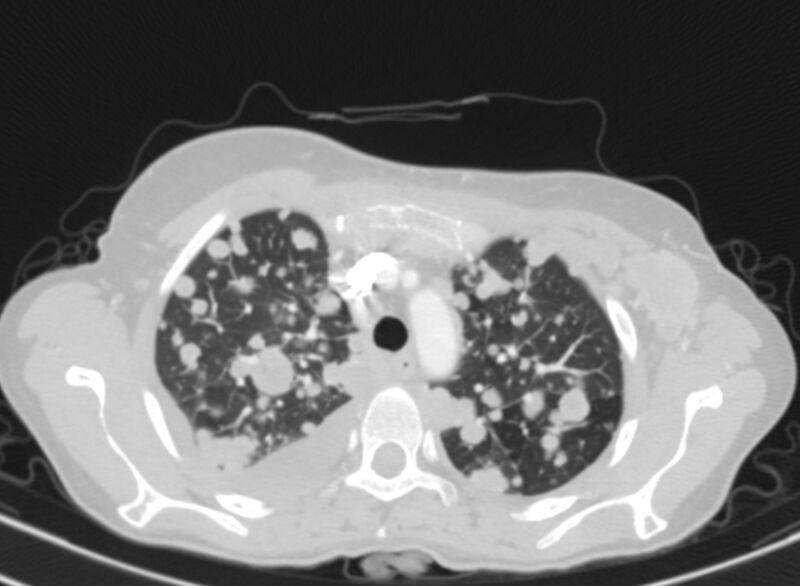 File:Cannonball metastases from breast cancer (Radiopaedia 91024-108569 Axial lung window 20).jpg