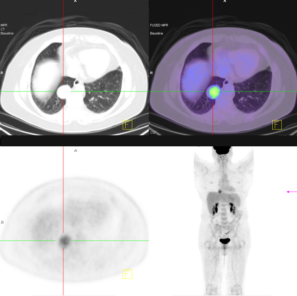 File:Carcinoid tumor - lung (Radiopaedia 44814-48645 18F-FDG PET-CT 1).PNG