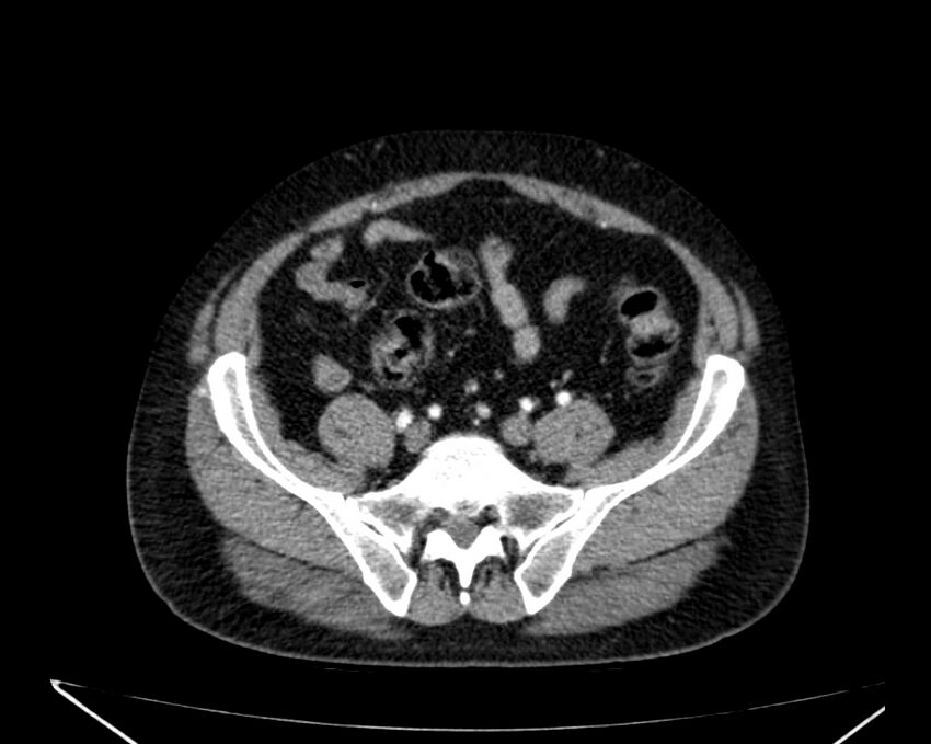 Carcinoid tumor with hepatic metastases (Radiopaedia 22651-22670 B 66).jpg
