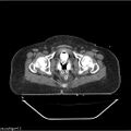 Carcinoma cervix- brachytherapy applicator (Radiopaedia 33135-34173 Axial non-contrast 36).jpg