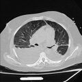 Cardiogenic pulmonary edema (Radiopaedia 29213-29609 Axial lung window 41).jpg