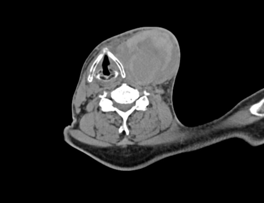 Carotid artery pseudoaneurysm (Radiopaedia 84030-99259 Axial non-contrast 33).jpg