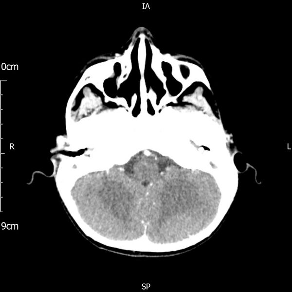 File:Cavernous sinus thrombosis (Radiopaedia 79414-92510 Axial Brain 63).jpg