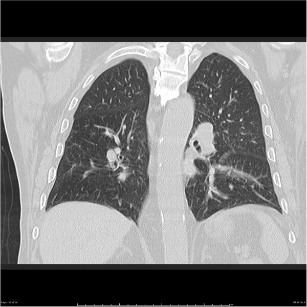 File:Cavitating left lower lobe lesion - squamous cell lung cancer (Radiopaedia 27749-28176 Coronal lung window 35).jpg