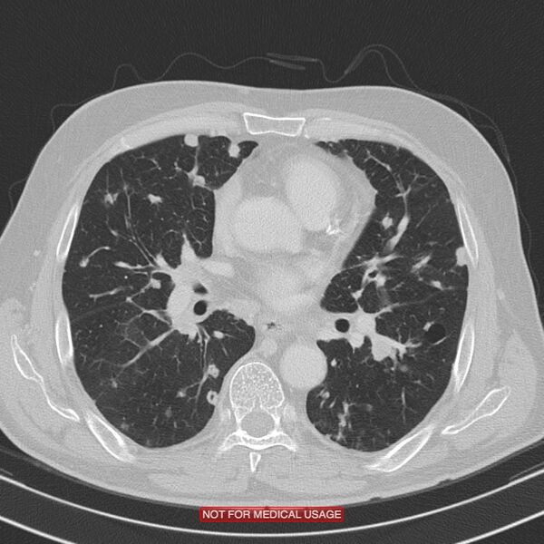 File:Cavitating pulmonary metastases (Radiopaedia 24920-25184 Axial lung window 12).jpg