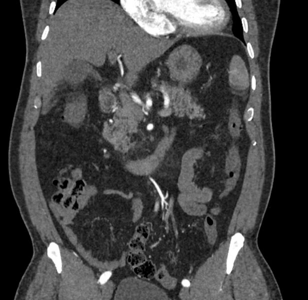 File:Celiac artery dissection (Radiopaedia 52194-58080 C 34).jpg